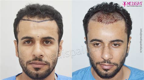 prada hair transplant dubai